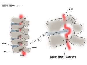 腰椎椎間板ヘルニアは激痛