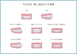 歯並び