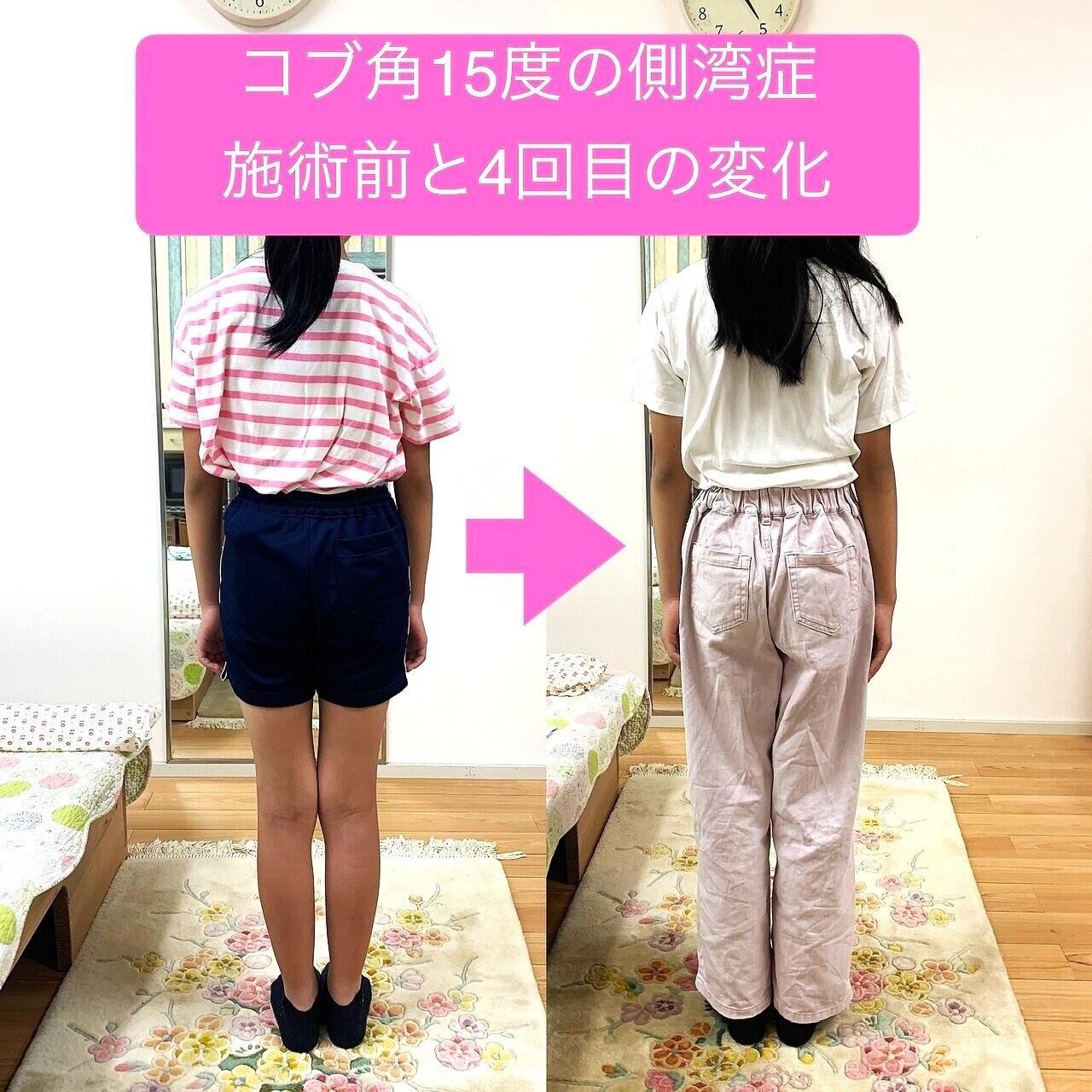 学校検診で「側弯」です　と言われた！