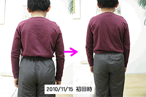 脊柱側弯症 ビフォーアフター 脊柱側弯症 ビフォーアフター