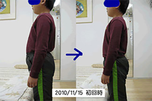 脊柱側弯症　ビフォーアフター