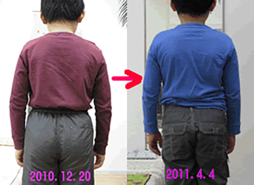 側湾症 半年のビフォーアフター 1回目と半年後の ビフォーアフターです。
