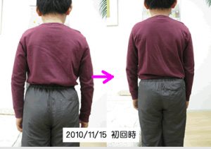 小学生の側弯症